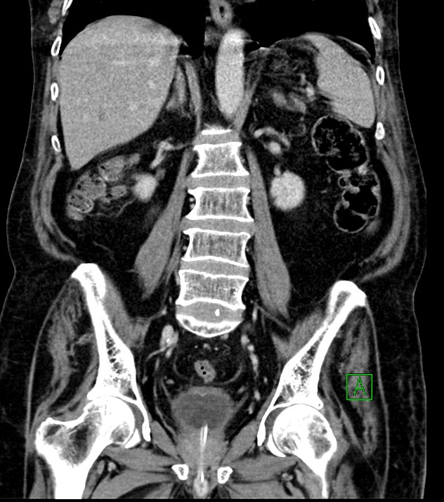 Cholangiocarcinoma with cerebral metastases (Radiopaedia 83519-98629 G 50).jpg