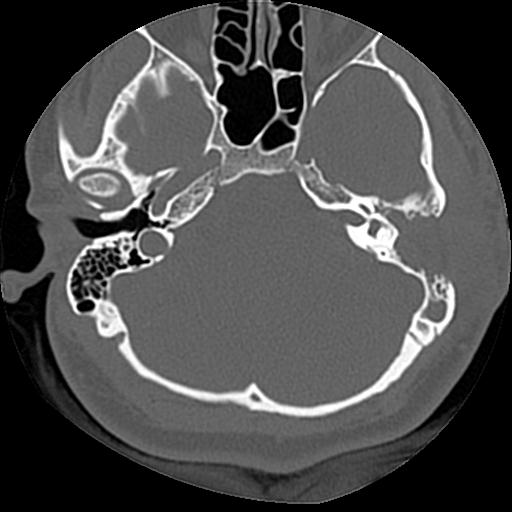 Cholesteatoma (Radiopaedia 84960-100474 Axial bone window 44).jpg