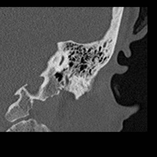 File:Cholesteatoma of the external ear (Radiopaedia 16540-16225 Coronal bone window 20).jpg