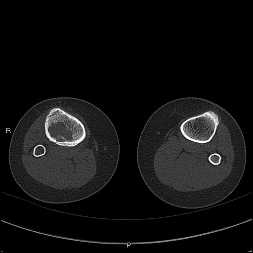 Chondroblastoma (Radiopaedia 62721-71030 Axial bone window 91).jpg