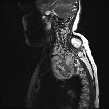 File:Chondrosarcoma - chest wall (Radiopaedia 65192-74200 Sagittal T2 14).jpg