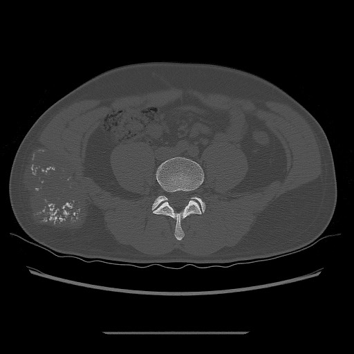 File:Chondrosarcoma of iliac wing (Radiopaedia 63861-72599 Axial bone window 30).jpg