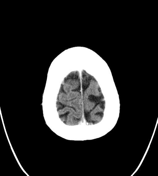 File:Chondrosarcoma of skull base- grade II (Radiopaedia 40948-43653 Axial Contrast 28).png
