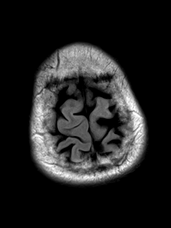 File:Chondrosarcoma of skull base- grade II (Radiopaedia 40948-43654 Axial T2 FLAIR 21).png