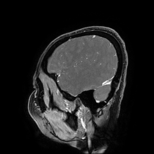 Chordoid glioma of third ventricle (Radiopaedia 91612-109340 F 167).jpg