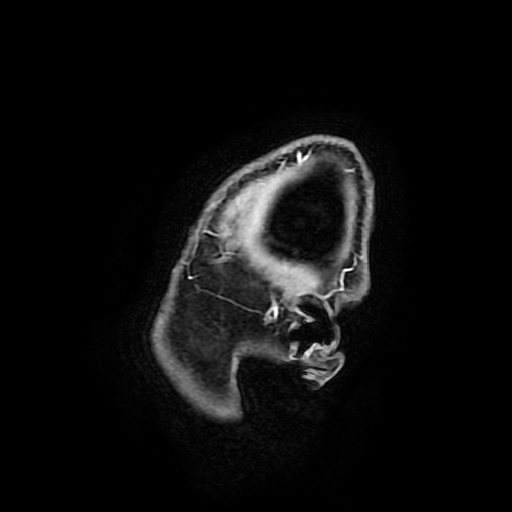 Chordoid glioma of third ventricle (Radiopaedia 91612-109340 F 18).jpg