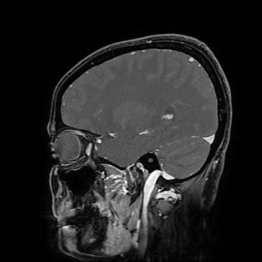 Chordoid glioma of third ventricle (Radiopaedia 91612-109340 F 70).jpg