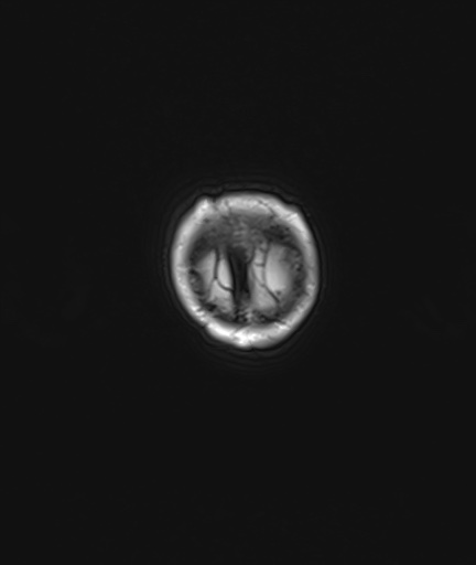 Choroid plexus papilloma (Radiopaedia 84612-100019 Coronal FLAIR 143).jpg
