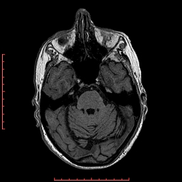 Choroid plexus xanthogranuloma (Radiopaedia 67843-77270 Axial T1 116).jpg
