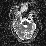 Choroid plexus xanthogranuloma - unilateral (Radiopaedia 85632-101393 Axial ADC 16).jpg
