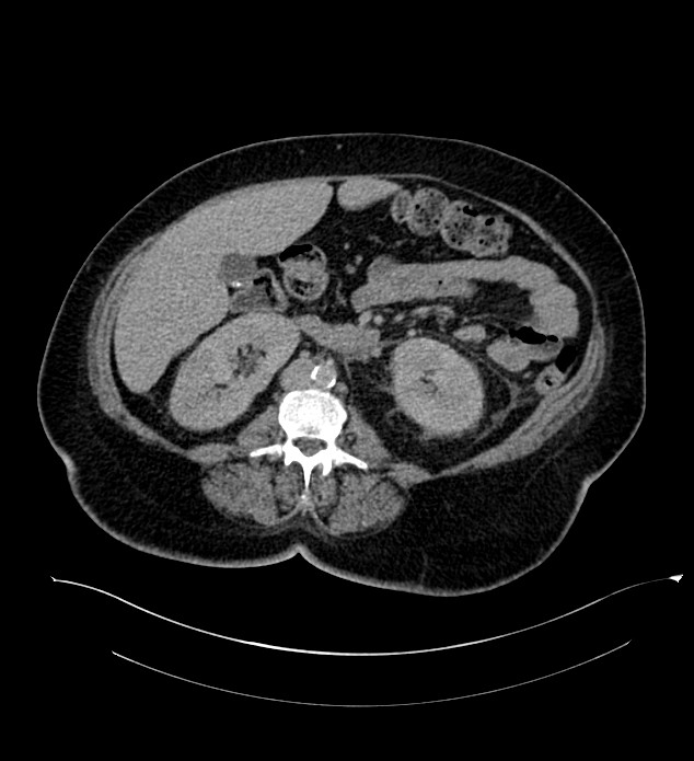 Chromophobe renal cell carcinoma (Radiopaedia 84239-99519 E 85).jpg