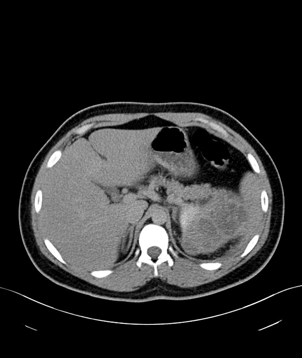 Chromophobe renal cell carcinoma (Radiopaedia 84255-99542 H 4).jpg