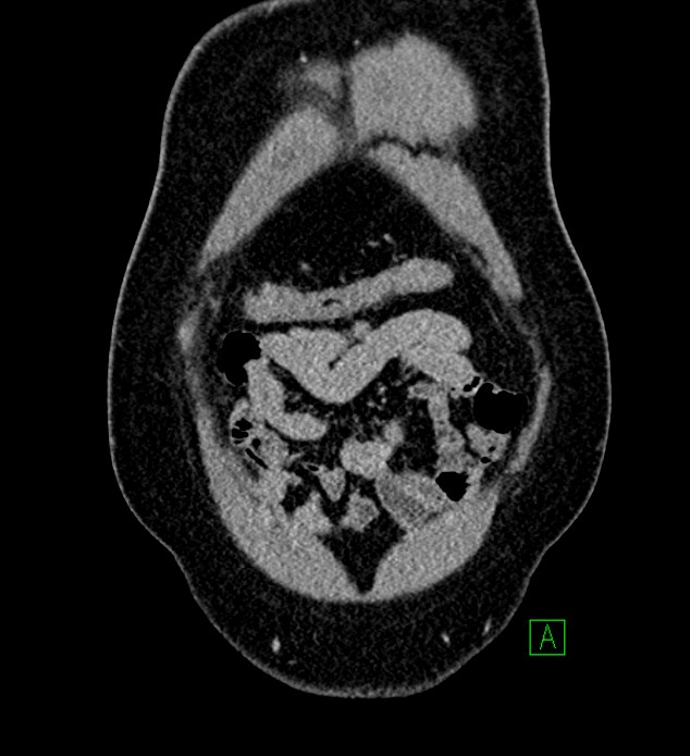 Chromophobe renal cell carcinoma (Radiopaedia 84286-99573 H 22).jpg