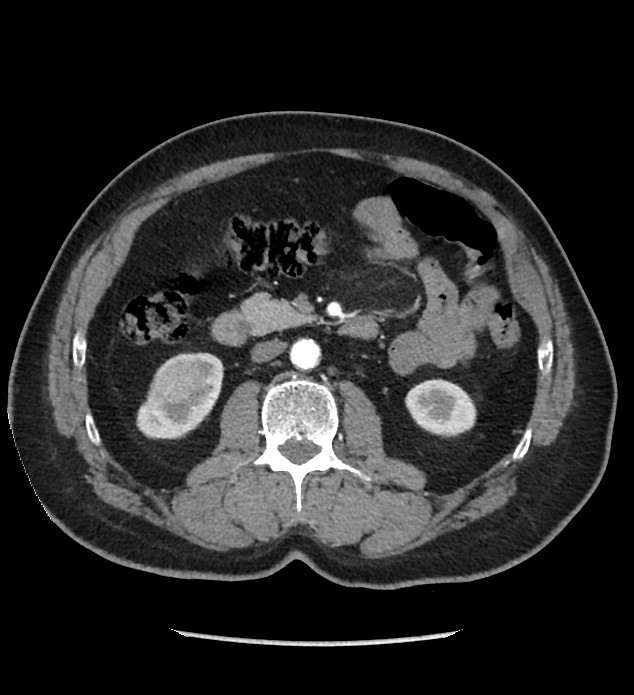 Chromophobe renal cell carcinoma (Radiopaedia 86879-103083 B 66).jpg