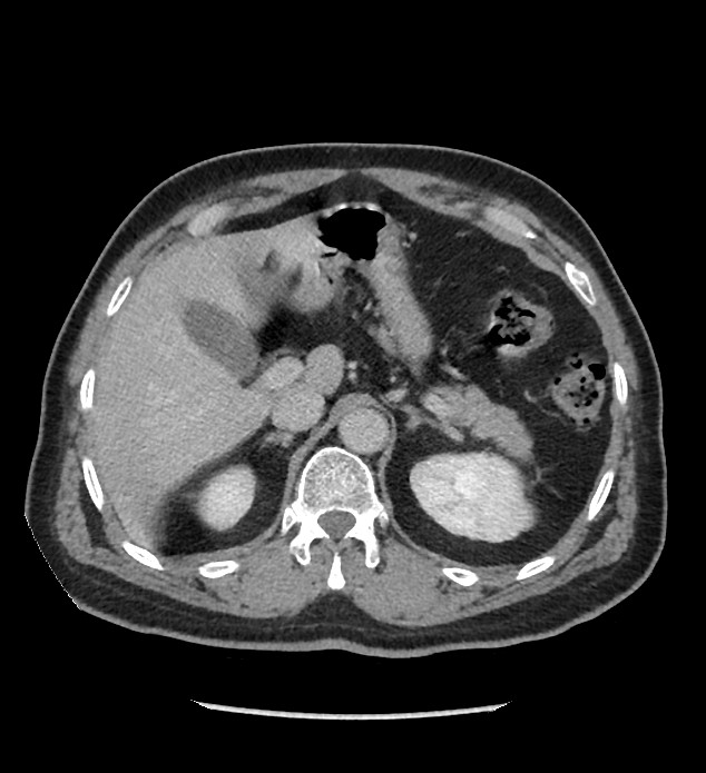 Chromophobe renal cell carcinoma (Radiopaedia 86879-103083 C 37).jpg
