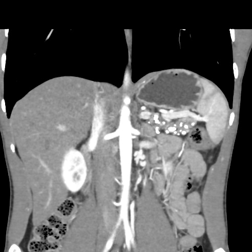 File:Chronic calcific pancreatitis (Radiopaedia 56280-62953 E 15).jpg