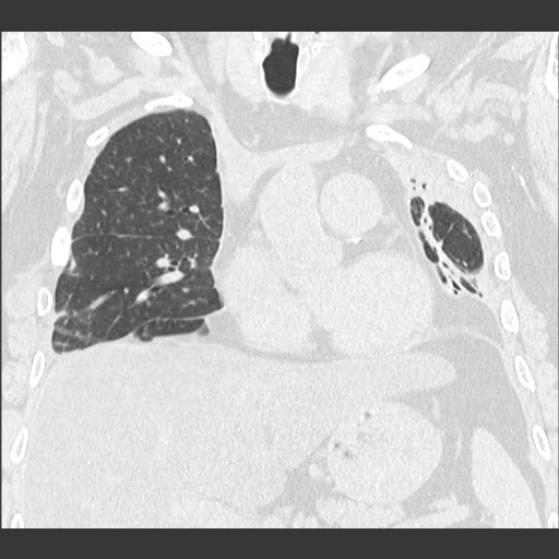 Chronic lung allograft dysfunction - restrictive form (Radiopaedia 60595-68316 Coronal lung window 48).jpg