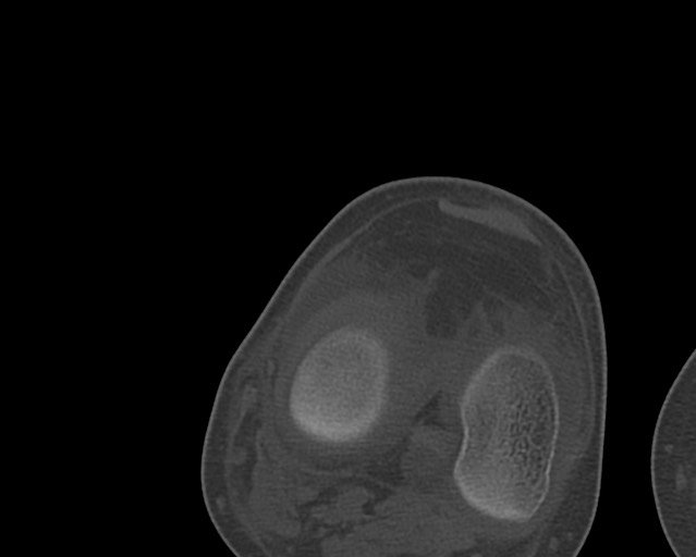 Chronic ostemyelitis of the femur with long sinus tract (Radiopaedia 74947-85982 Axial bone window 227).jpg