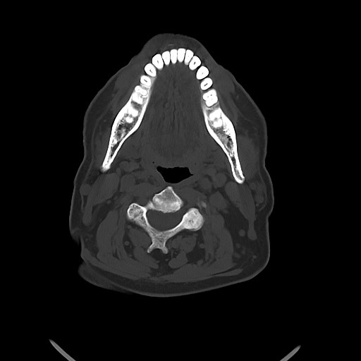 Chronic osteomyelitis - calvarial (severe) (Radiopaedia 69668-79616 Axial bone window 8).jpg