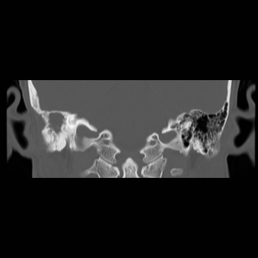 File:Chronic otomastoiditis (Radiopaedia 27138-27309 Coronal bone window 14).jpg