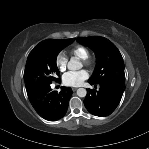Chronic pulmonary embolus (Radiopaedia 39129-41341 Axial C+ CTPA 59).png