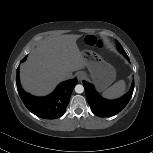 Chronic pulmonary embolus (Radiopaedia 39129-41341 Axial C+ CTPA 86).png