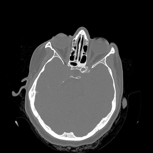 Chronic sinusitis with intra-sinus calcification (Radiopaedia 63919-72668 Axial bone window 11).jpg