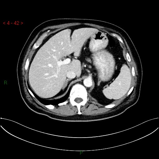 File:Circumaortic left renal vein and doubled left renal arteries (Radiopaedia 52268-58158 B 2).jpg