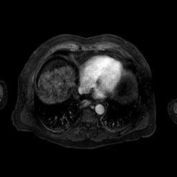 Cirrhosis and hepatocellular carcinoma in the setting of hemochromatosis (Radiopaedia 75394-86594 Axial T1 C+ fat sat 161).jpg