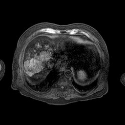 Cirrhosis and hepatocellular carcinoma in the setting of hemochromatosis (Radiopaedia 75394-86594 Axial T1 C+ fat sat 66).jpg