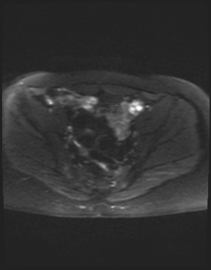 Class II Mullerian duct anomaly- unicornuate uterus with rudimentary horn and non-communicating cavity (Radiopaedia 39441-41755 Axial DWI 11).jpg