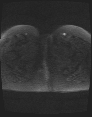 File:Class II Mullerian duct anomaly- unicornuate uterus with rudimentary horn and non-communicating cavity (Radiopaedia 39441-41755 Axial DWI 64).jpg