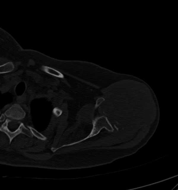 Clear cell chondrosarcoma - humerus (Radiopaedia 63104-71612 Axial bone window 30).jpg