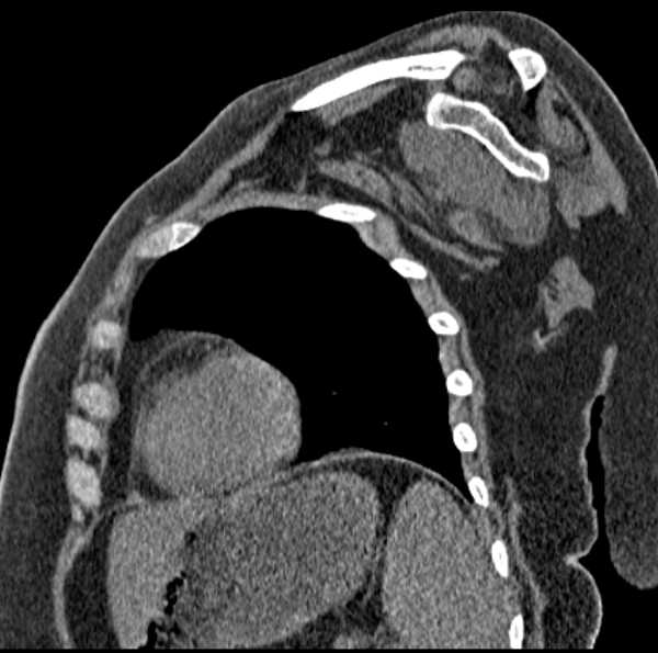File:Clear cell chondrosarcoma - humerus (Radiopaedia 63104-71612 D 40).jpg
