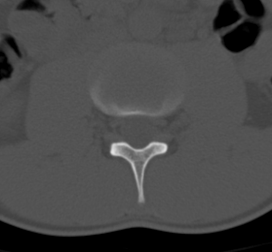 Clear cell meningoma - lumbar spine (Radiopaedia 60116-67691 Axial bone window 31).png