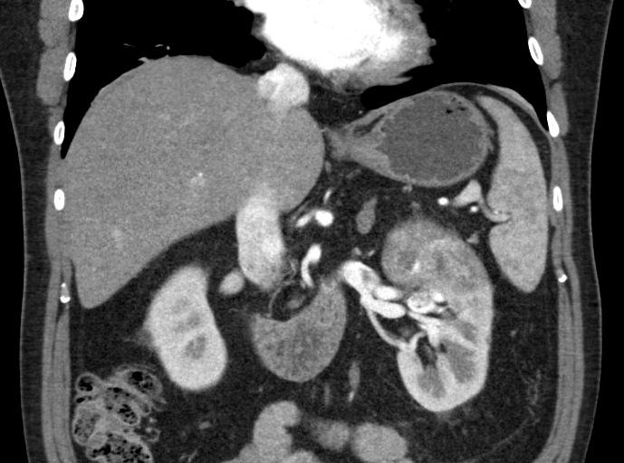 File:Clear cell renal cell carcinoma (Radiopaedia 61449-69393 C 12).jpg