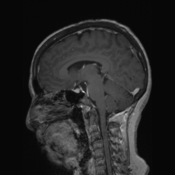 File:Clival meningioma (Radiopaedia 53278-59248 F 31).jpg