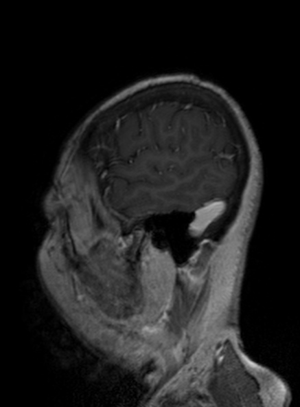 File:Clival meningioma (Radiopaedia 53278-59248 Sagittal T1 C+ 153).jpg