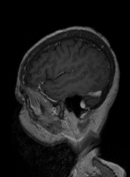 Clival meningioma (Radiopaedia 53278-59248 Sagittal T1 C+ 346).jpg