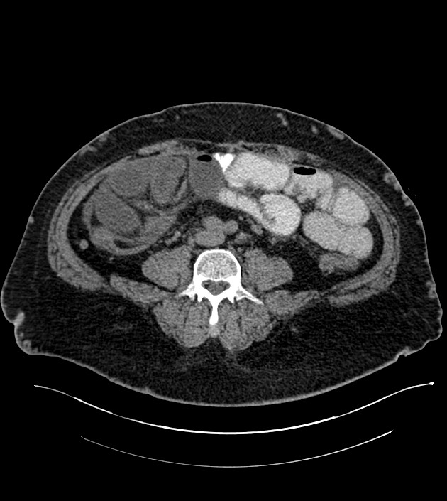 Closed-loop small bowel obstruction-internal hernia (Radiopaedia 78439-91096 Axial non-contrast 96).jpg