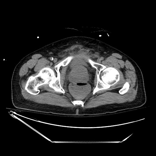 File:Closed loop obstruction due to adhesive band, resulting in small bowel ischemia and resection (Radiopaedia 83835-99023 Axial non-contrast 149).jpg
