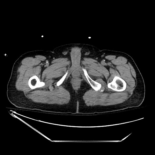 File:Closed loop obstruction due to adhesive band, resulting in small bowel ischemia and resection (Radiopaedia 83835-99023 Axial non-contrast 171).jpg