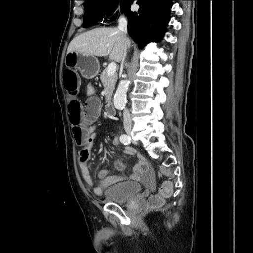 File:Closed loop obstruction due to adhesive band, resulting in small bowel ischemia and resection (Radiopaedia 83835-99023 F 88).jpg