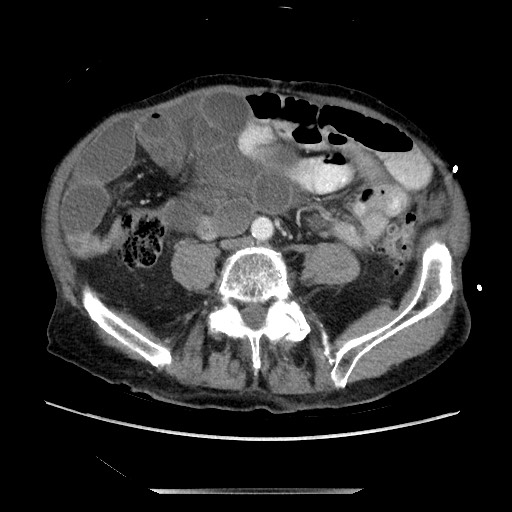 Closed loop small bowel obstruction - adhesive disease and hemorrhagic ischemia (Radiopaedia 86831-102990 A 121).jpg