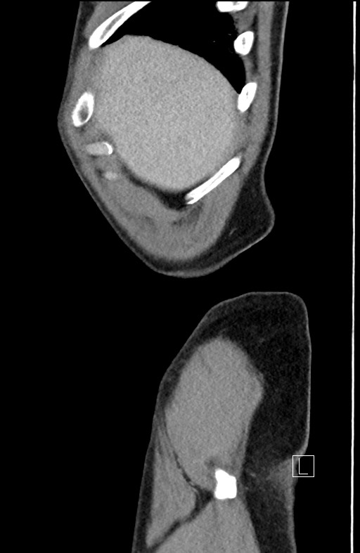 Closed loop small bowel obstruction - internal hernia (Radiopaedia 57806-64778 C 105).jpg