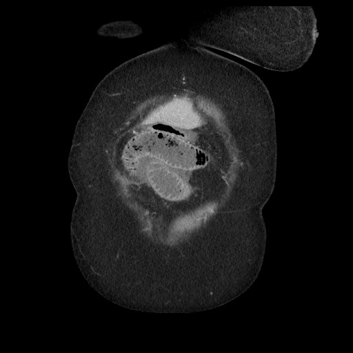 Closed loop small bowel obstruction - internal hernia (Radiopaedia 65402-74450 B 12).jpg