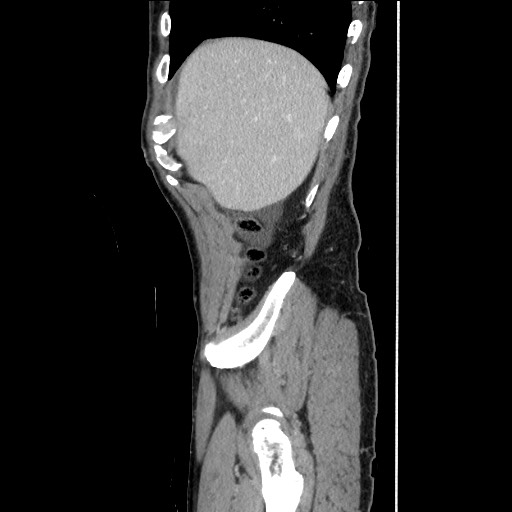 Closed loop small bowel obstruction - omental adhesion causing "internal hernia" (Radiopaedia 85129-100682 C 39).jpg