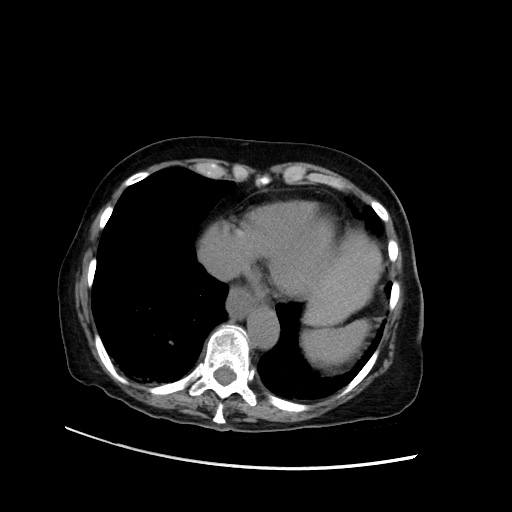 File:Closed loop small bowel obstruction due to adhesive band, with intramural hemorrhage and ischemia (Radiopaedia 83831-99017 Axial non-contrast 24).jpg