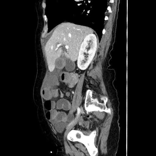 Closed loop small bowel obstruction due to adhesive band, with intramural hemorrhage and ischemia (Radiopaedia 83831-99017 D 79).jpg