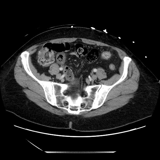 File:Closed loop small bowel obstruction due to adhesive bands - early and late images (Radiopaedia 83830-99014 A 113).jpg